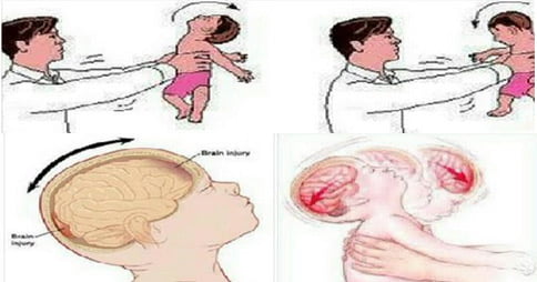 sindrome del bambino scosso