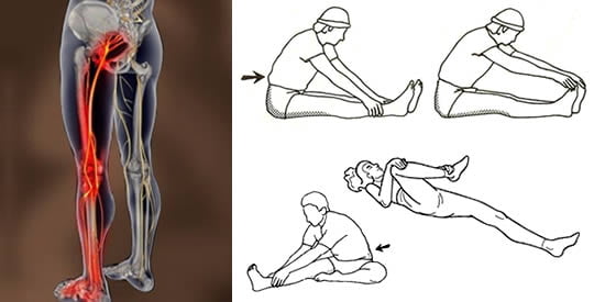 come sbloccare il nervo sciatico