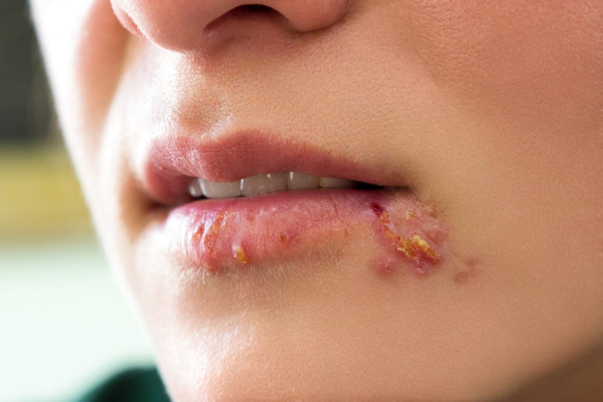 come sbarazzarsi dellherpes labiale per AdobeStock 115432582 1