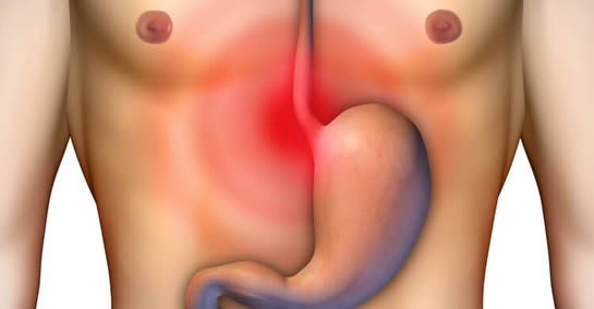 reflusso gastroesofageo