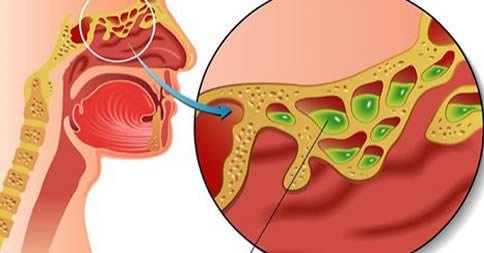 un modo efficace per stappare il naso