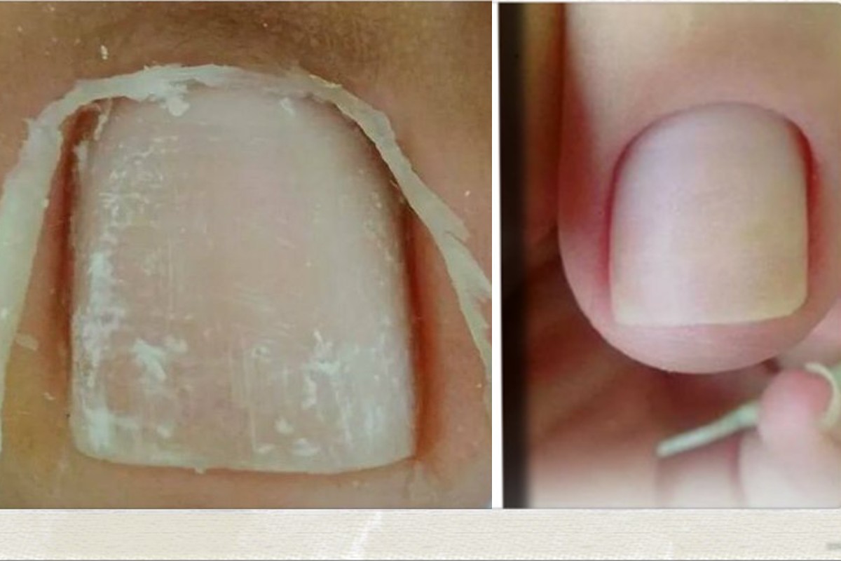 rimuovere le cuticole in modo rimuover cuticole