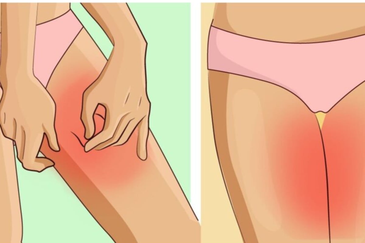 sfregamento interno cosce i rimedi irritanzione interno coscia