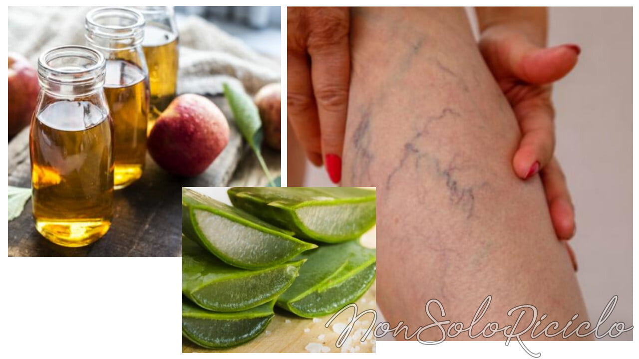 aceto e aloe per le vene varicose