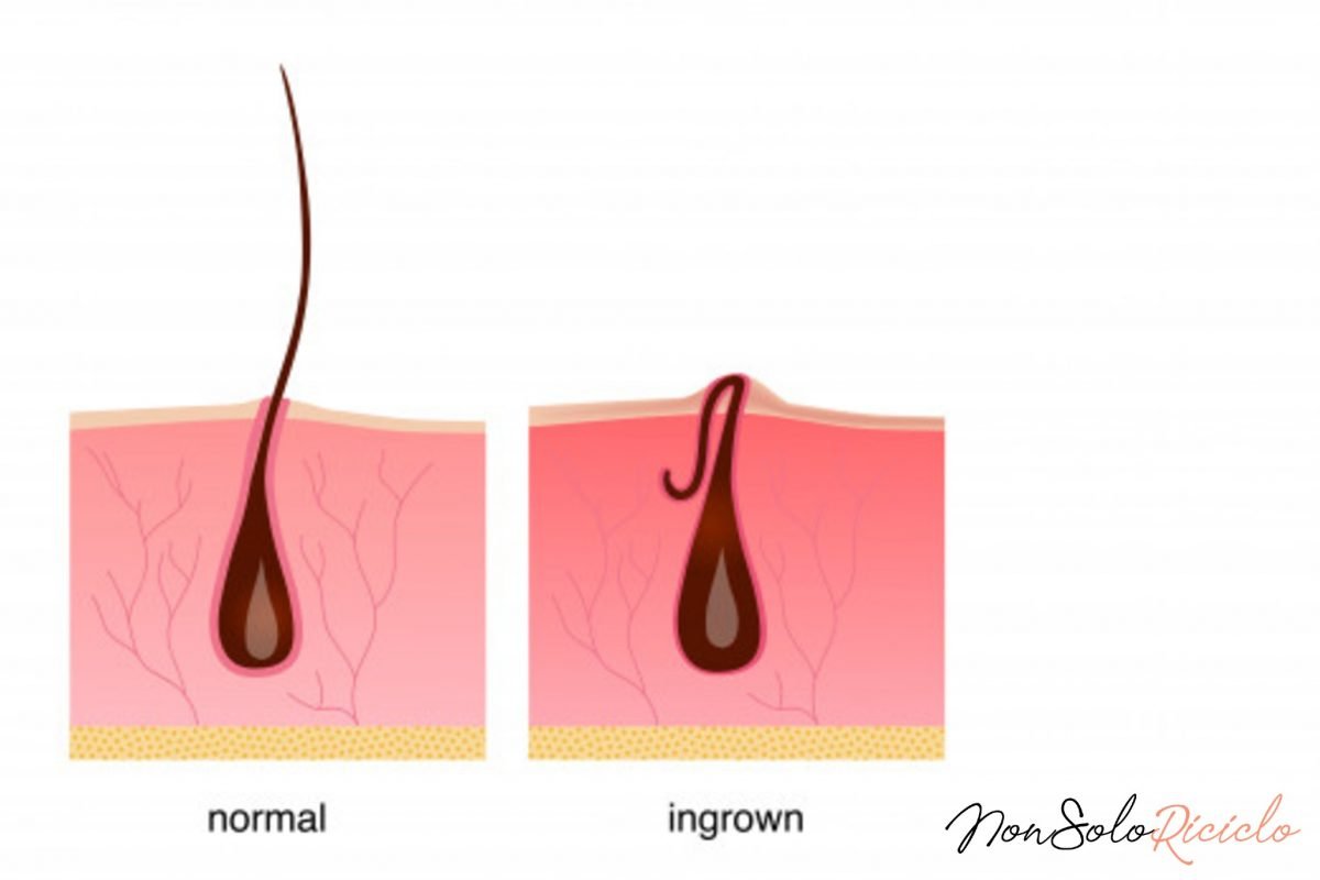 come eliminare un pelo incarnito 7