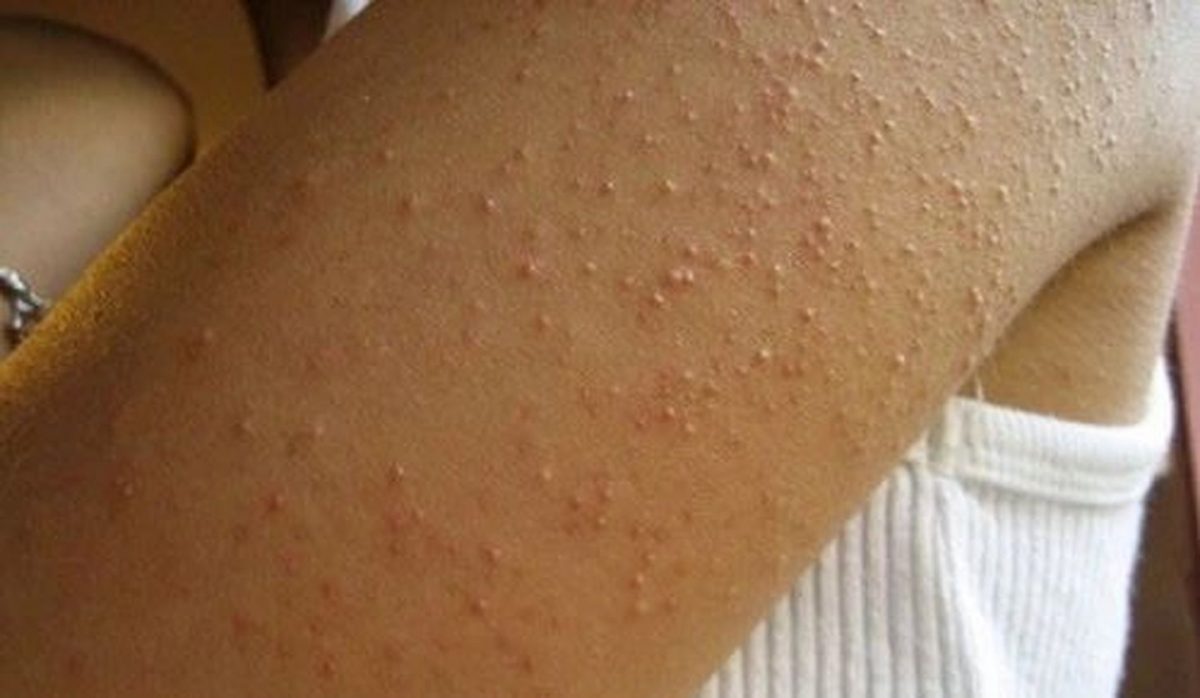 hai queste bollicine sulle braccia v2 6e4a100fb5cfb14baecc6eeb94b306ef 1440w