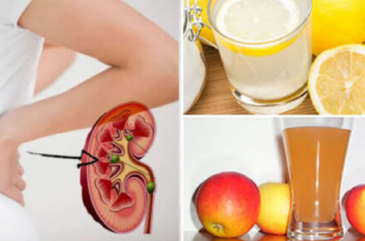 3 modi per combattere e calcolosi