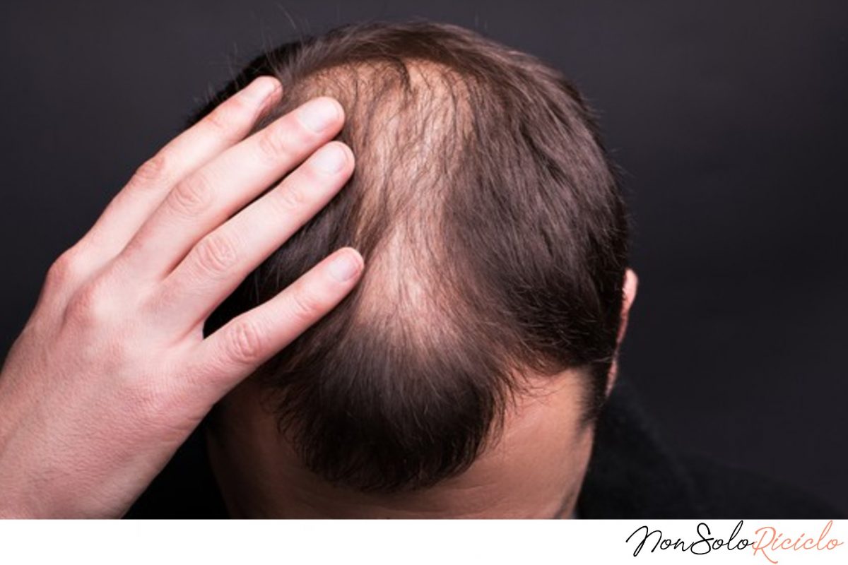 capelli diradati cause e rimedi 51