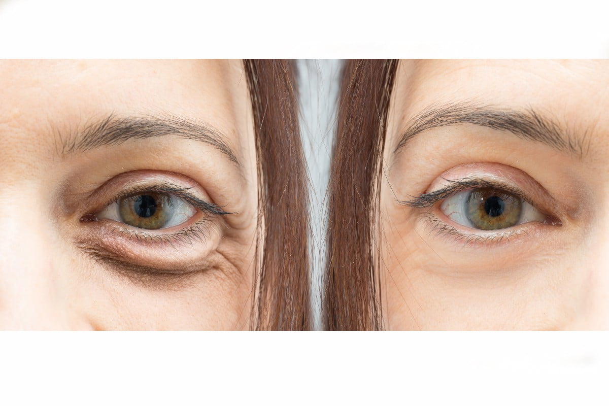 8 rimedi naturali per prevenire zampe di gallina