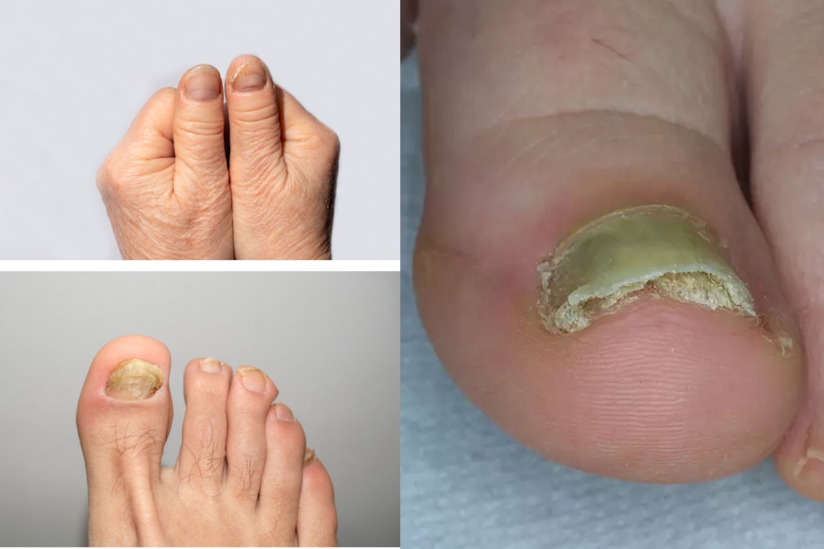 micosi unghie piedi e mani micosi mani e piedi