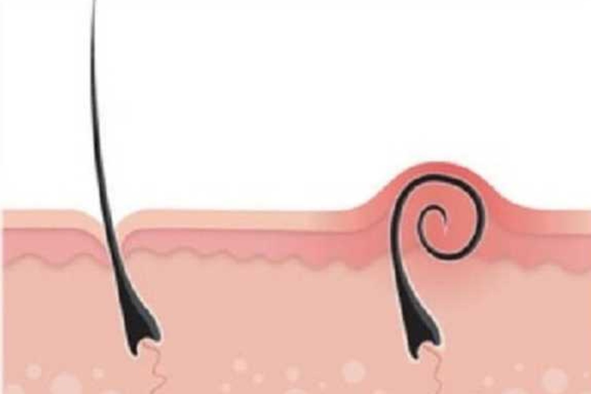 come rimuovere in poche mosse peli incarniti