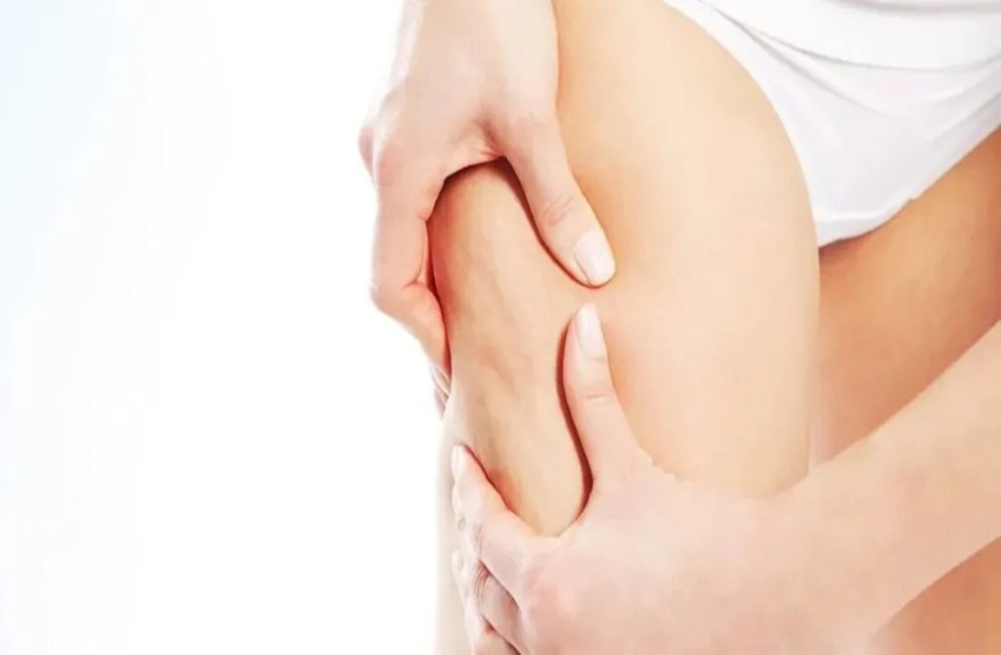 La - cellulite - Pianetadonne