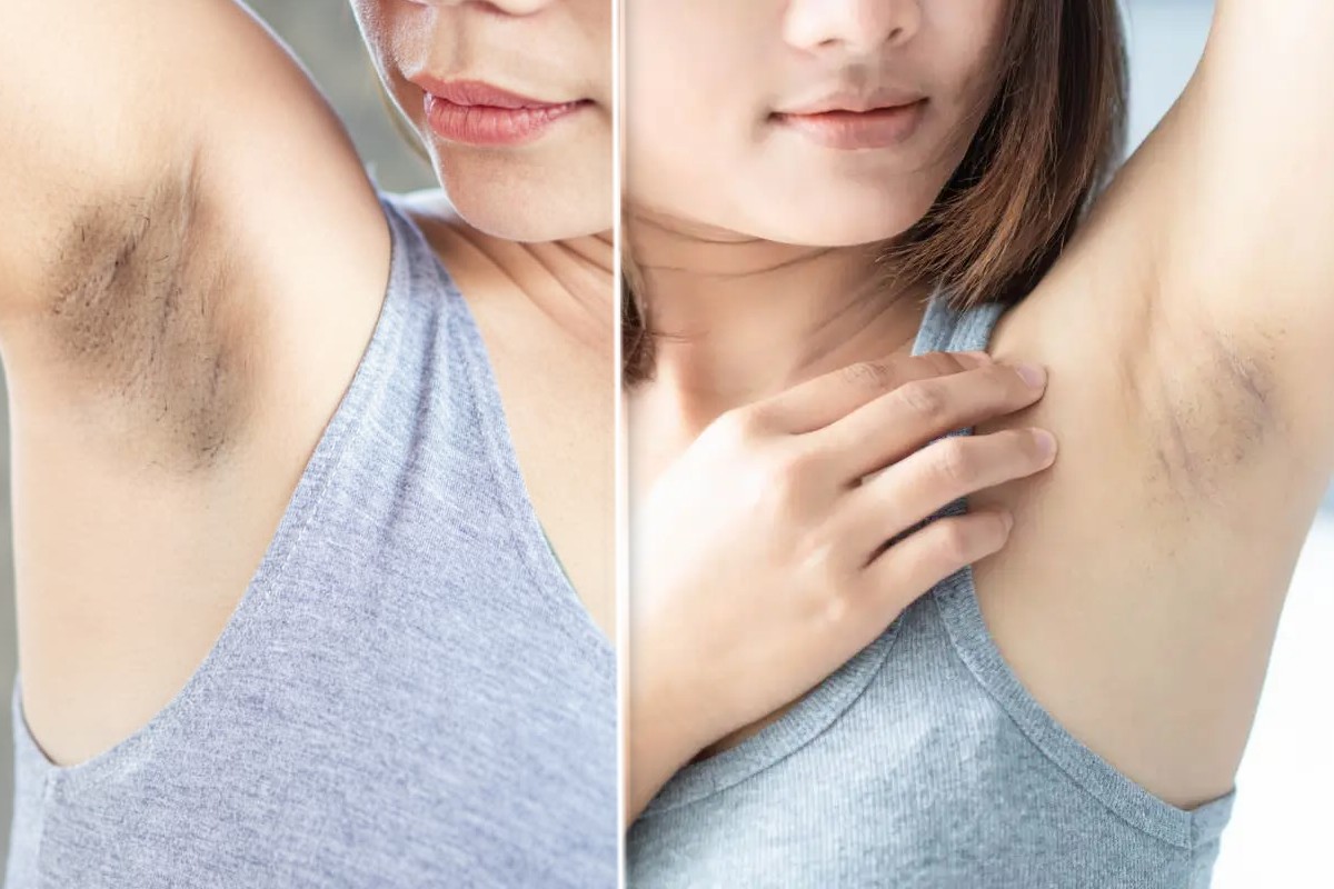 aloni scuri sotto le ascelle alone scuro ascelle