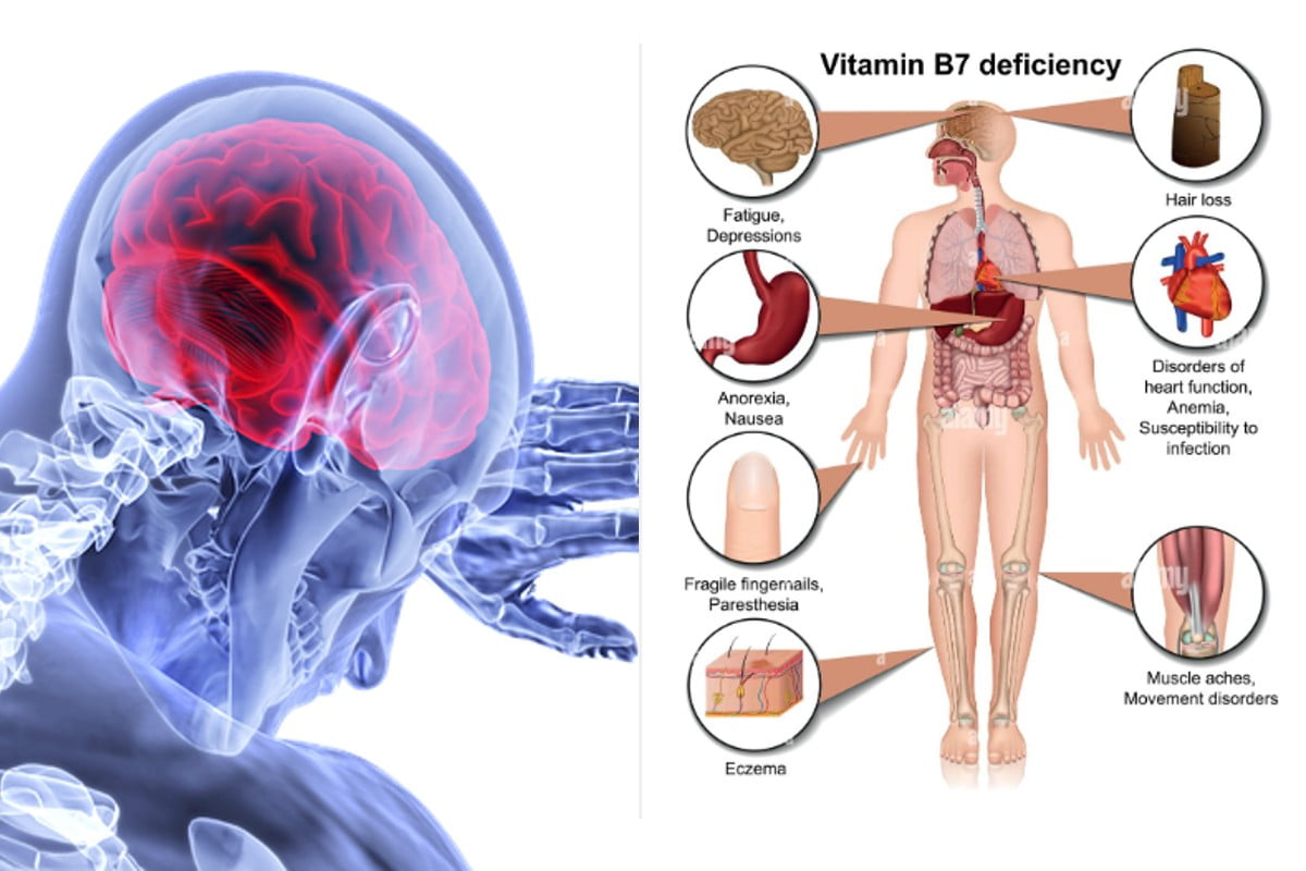 i 7 sintomi principali che carenza vitamina D